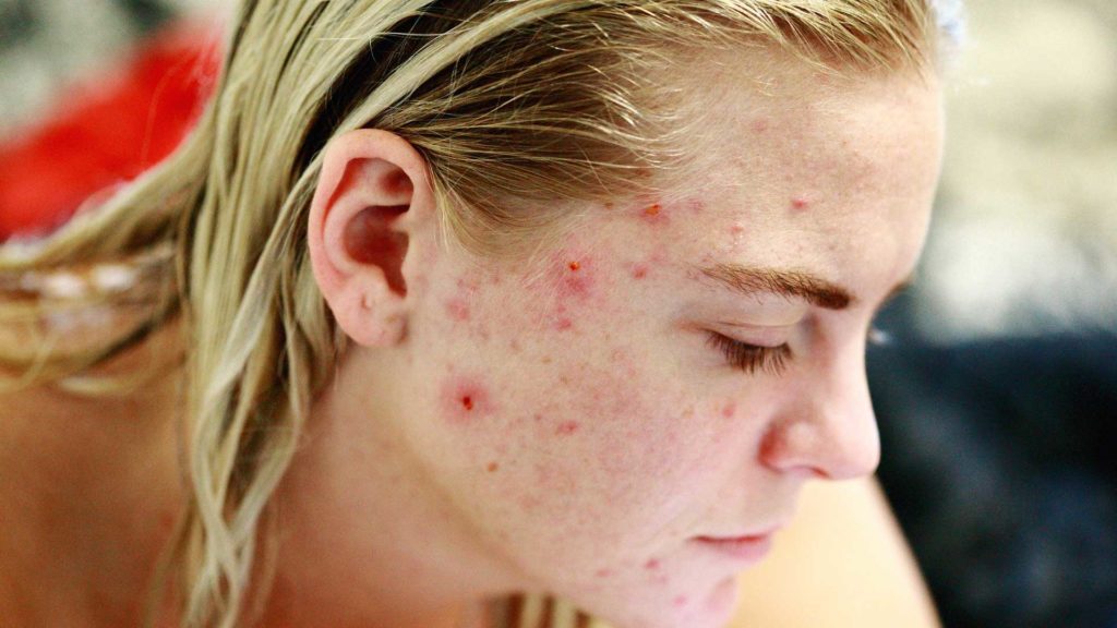 Five-Guaranteed-Tips-to-Keep-Away-From-Pesky-Pimples-on-lifehack